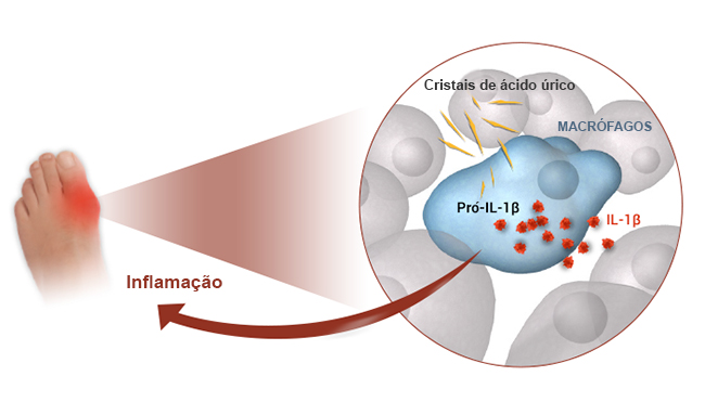 gota-e-cristais-de-acido-urico