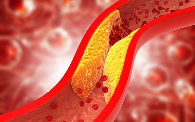 Clogged arteries, Cholesterol plaque in artery colesterol-veia-entupida