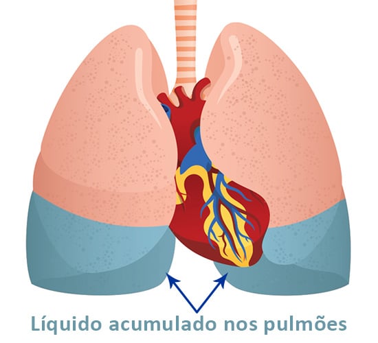 líquido acumulado nos pulmões
